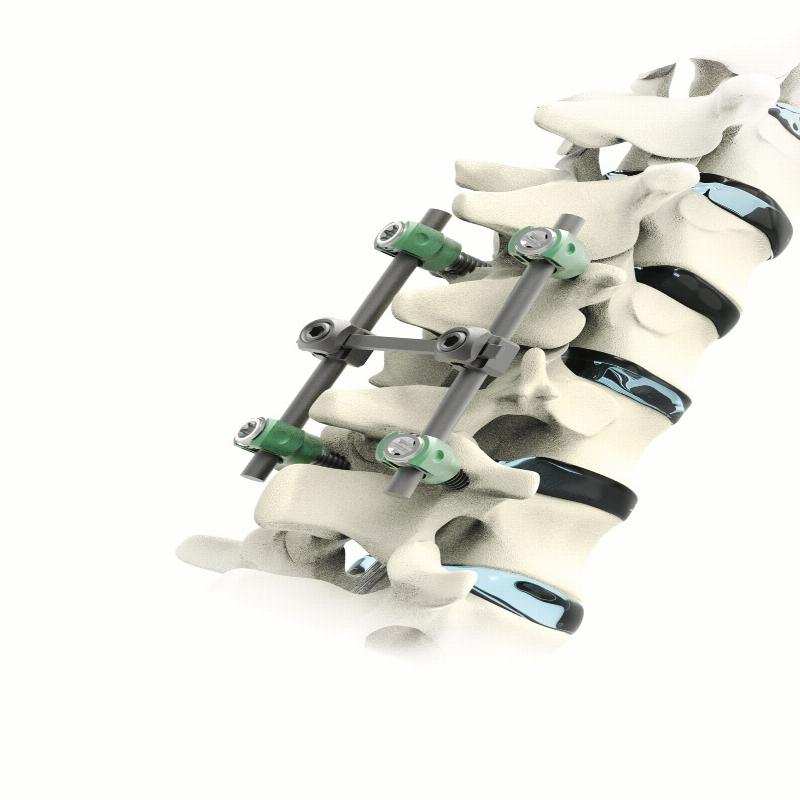 VERTAUX - Система для транспедикулярної фіксації хребта (10 гвинтів)